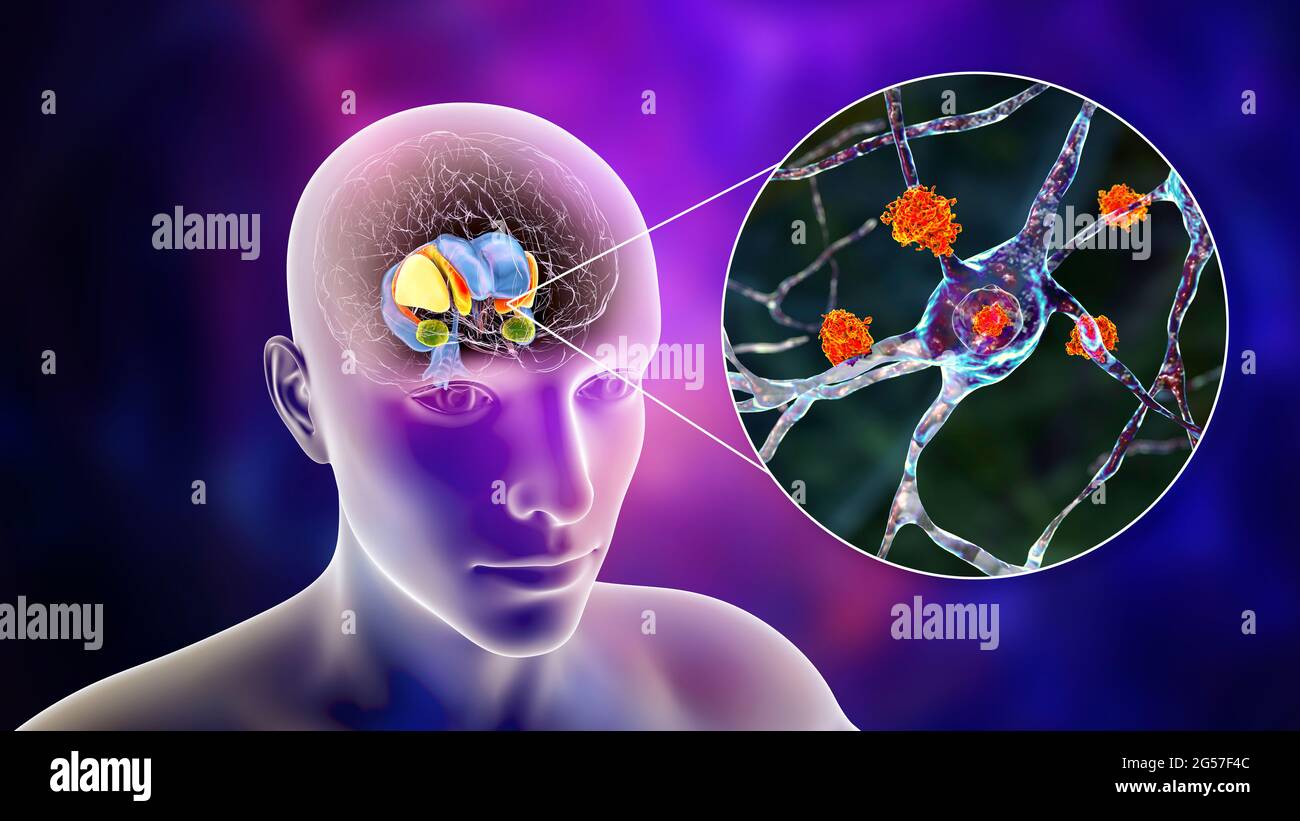 Dorsale Striatum bei der Huntington-Krankheit, Illustration Stockfoto