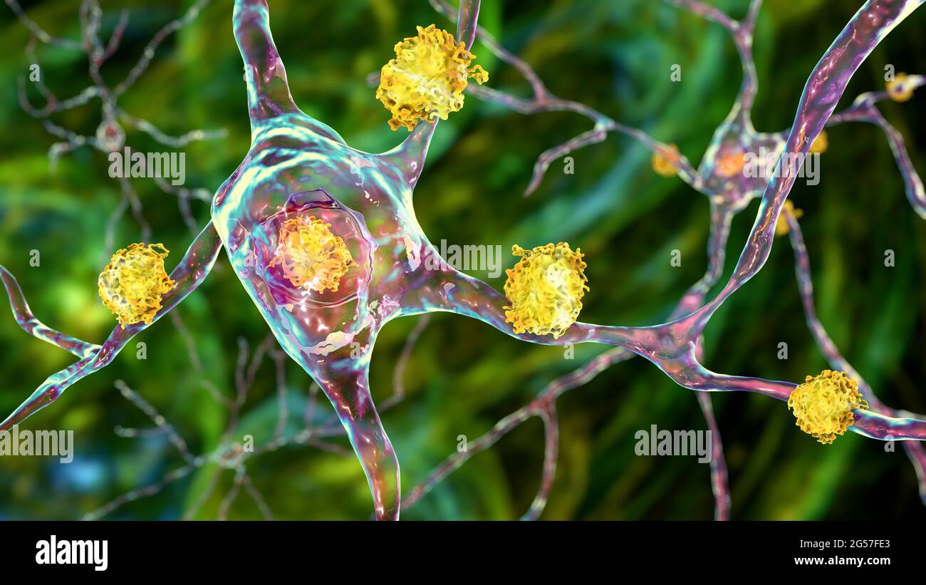 Neuronale Einschlüsse bei der Huntington-Krankheit, Illustration Stockfoto