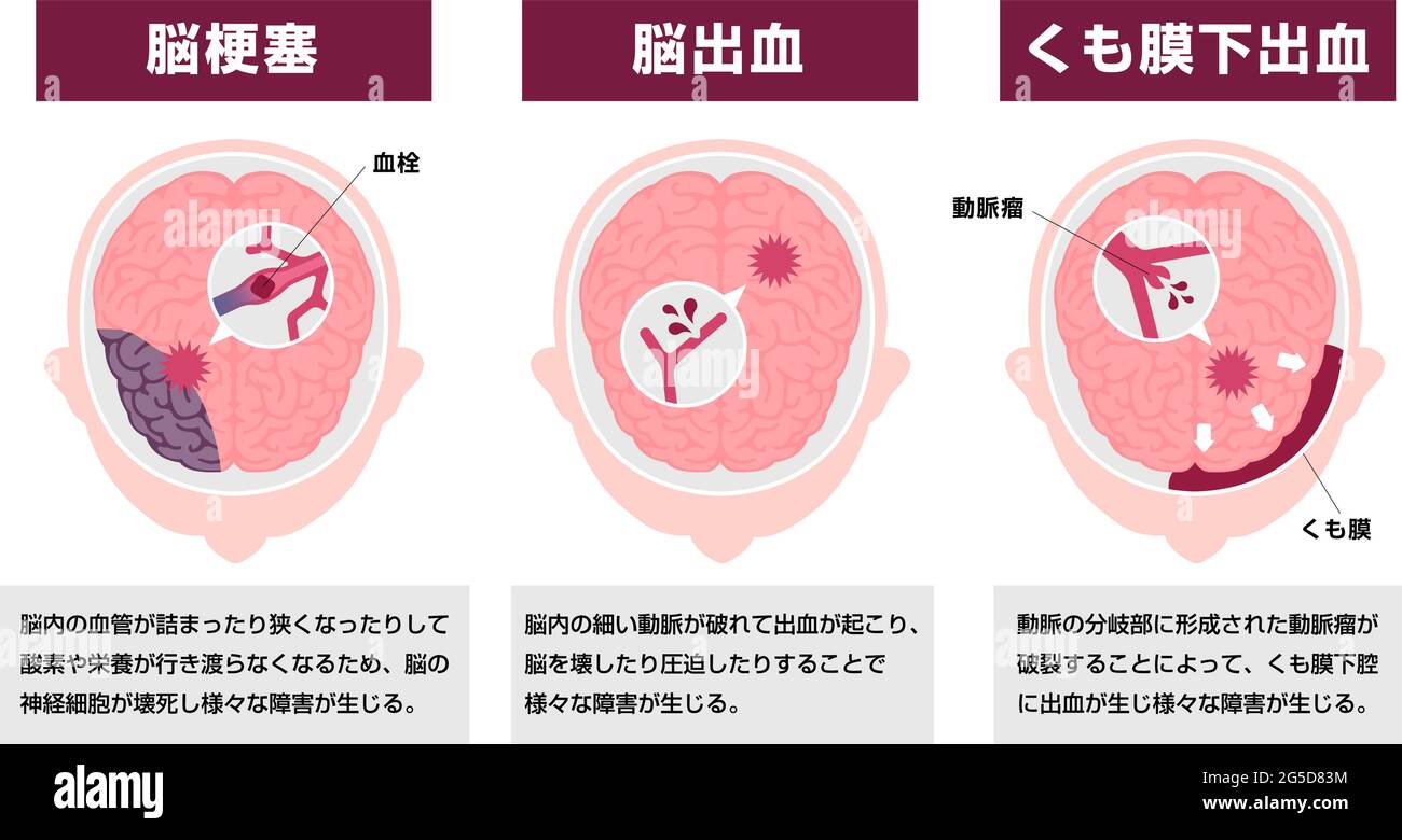 Arten der menschlichen Gehirn Schlaganfall Vektor Illustration Stock Vektor