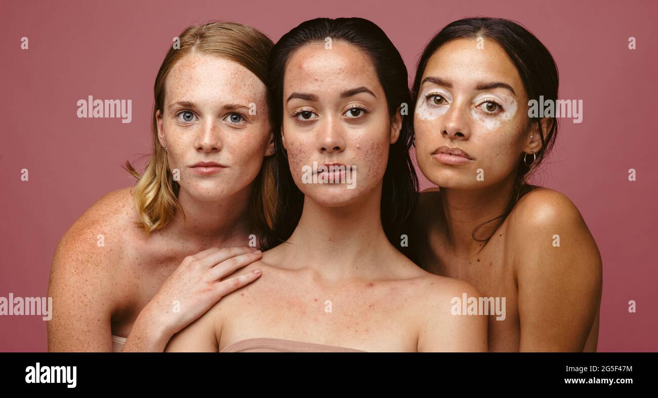 Nahaufnahme von Frauen mit Hautproblemen zusammen auf rosa Hintergrund. Porträt von drei selbstbewussten Frauen mit Hautstörungen. Stockfoto