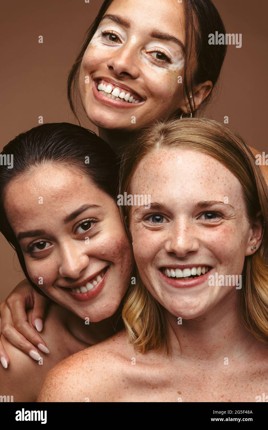 Nahaufnahme eines Porträts von drei lächelnden jungen Frauen zusammen. Porträt einer Frau mit Hautproblemen in fröhlicher Stimmung, die Selbstakzeptanz und Körper p darstellt Stockfoto