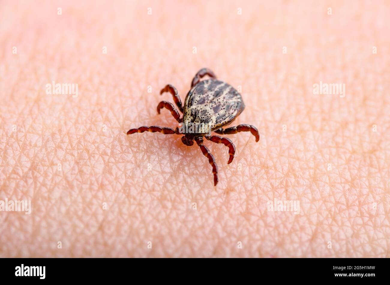 Lyme-Borreliose infizierte Tick Mite Insekt kriechen auf der Haut. Enzephalitis Virus oder Lyme-Borreliose Infektiöse Dermacentor Tick Arachnid Parasiten Close-Up Stockfoto