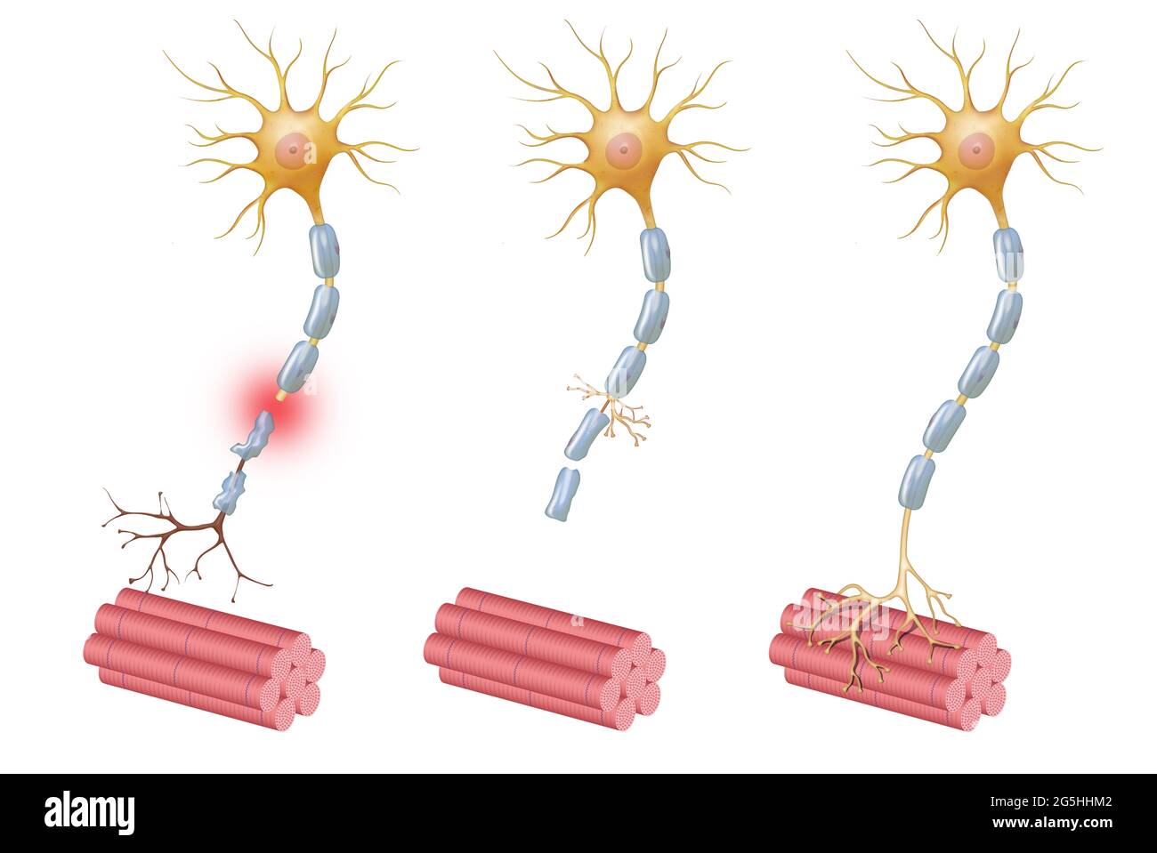 Sensorische neuropathie -Fotos und -Bildmaterial in hoher Auflösung – Alamy