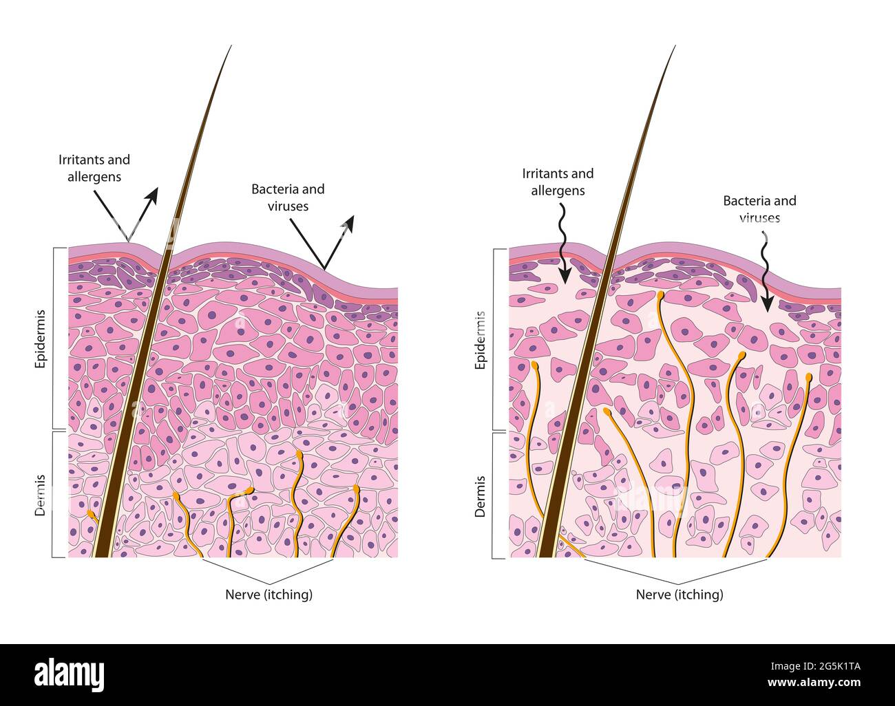 Normale und trockene Haut. Diagramm Stockfoto