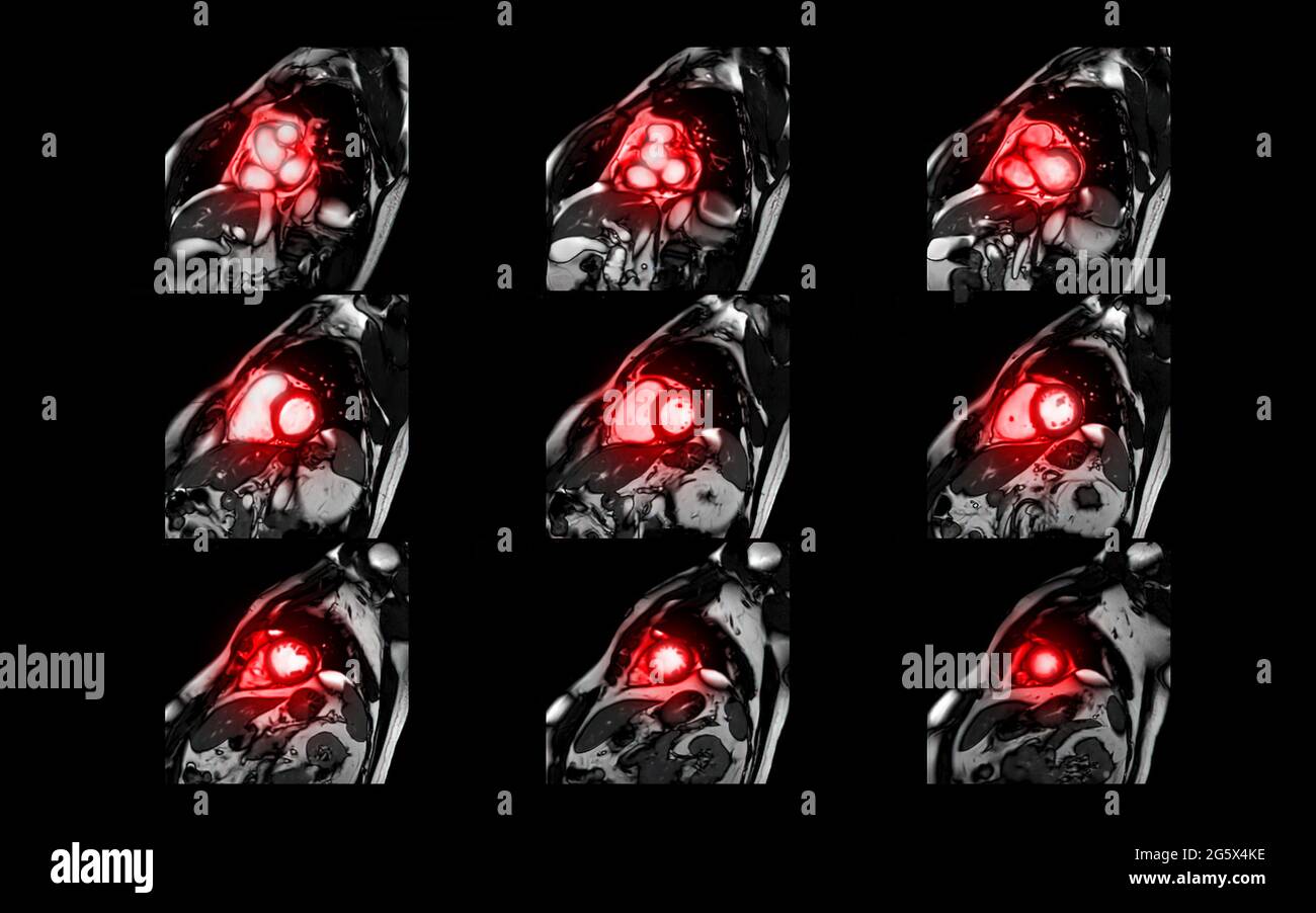 MRT Herz- oder Herz-MRT-Magnetresonanztomographie des Herzens in Kurzachsenansicht mit Querschnitten des linken und rechten Ventrikels zur Erkennung von h Stockfoto