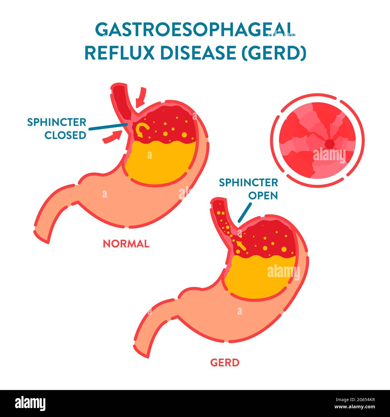 Gastroösophageale Refluxkrankheit, Illustration Stockfoto