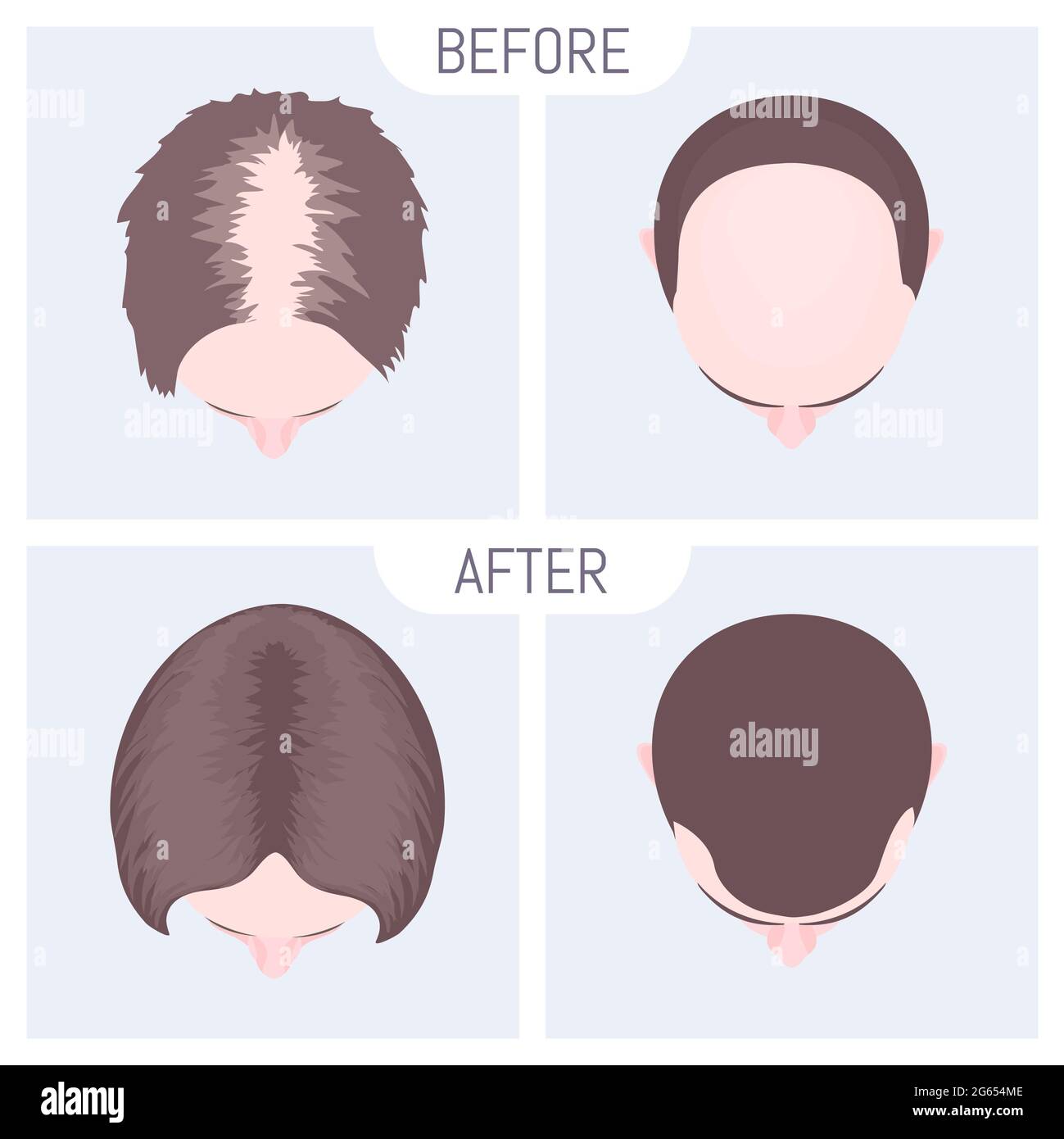 Weibliche und männliche Alopezie-Behandlung, Illustration Stockfoto