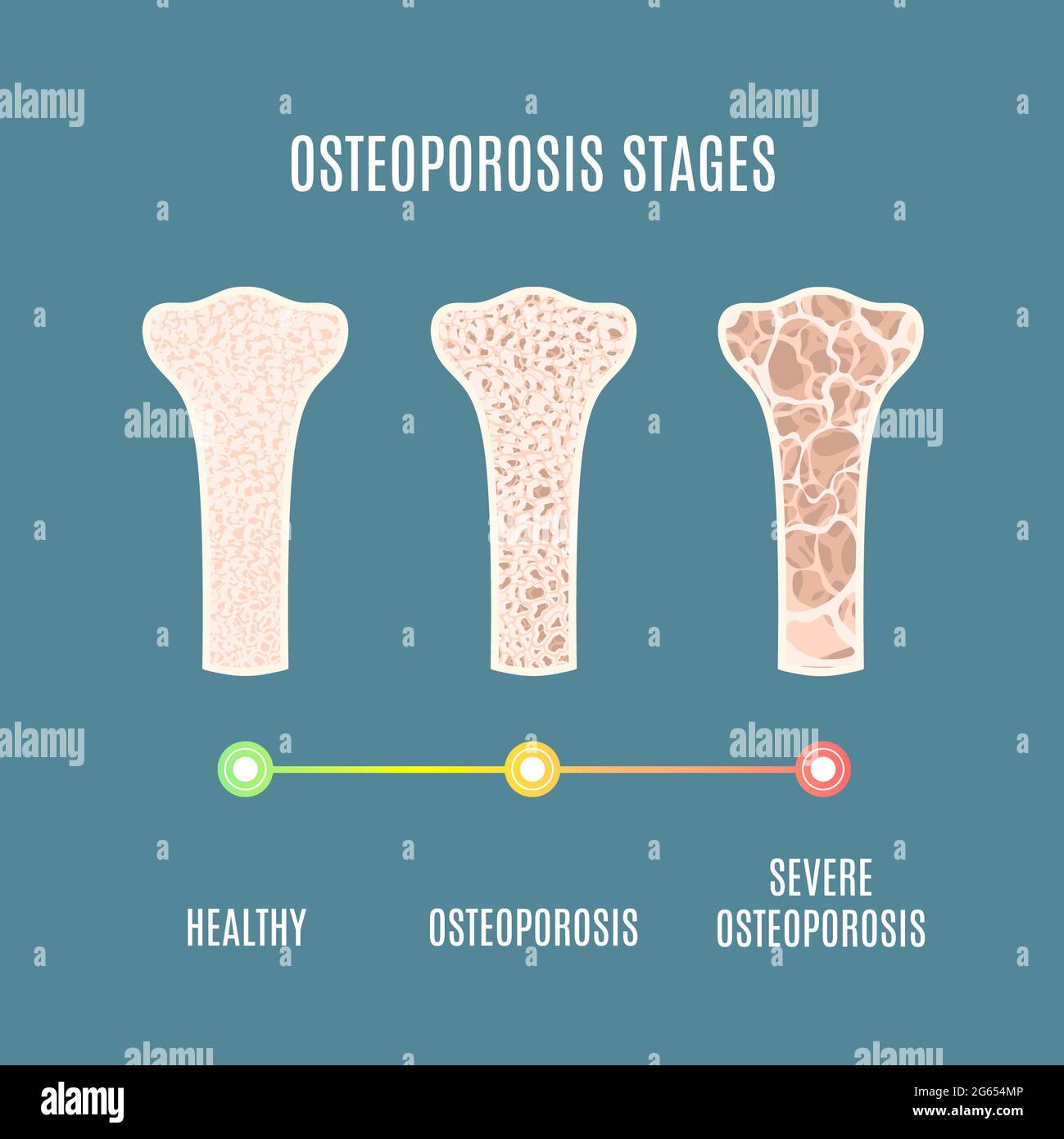 Osteoporose, Illustration Stockfoto