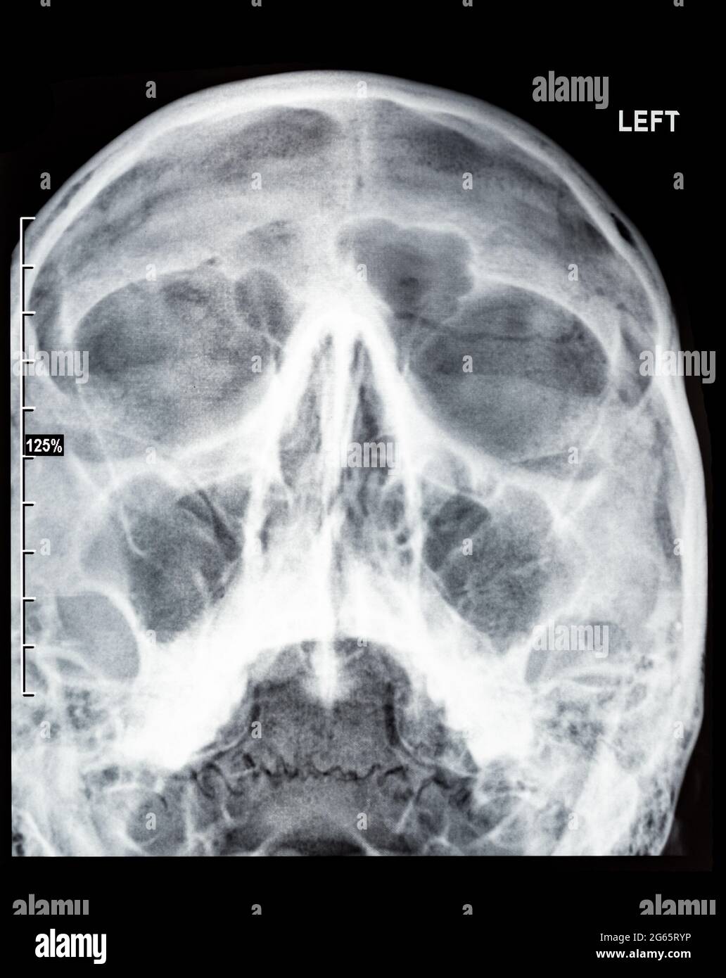 Radiographie eines menschlichen Schädels Paranasale Nasennebenhöhlen Rhinosinusitis diagnostische Sinusitis Röntgenstrahlen Stockfoto