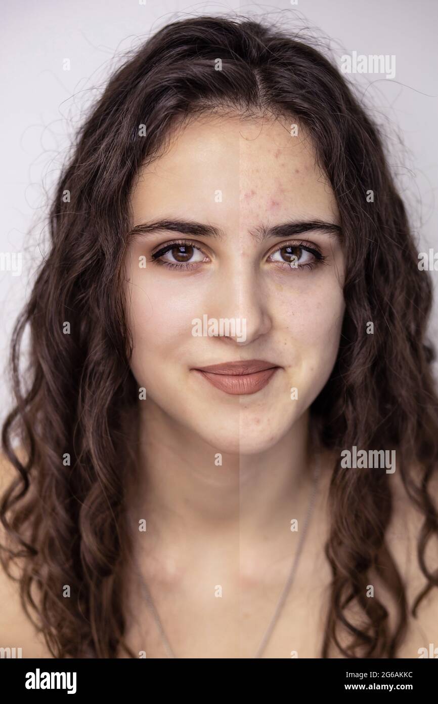 Vor und nach Gesichtshaut Foto von einem jungen, schönen Brünette Mädchen Stockfoto