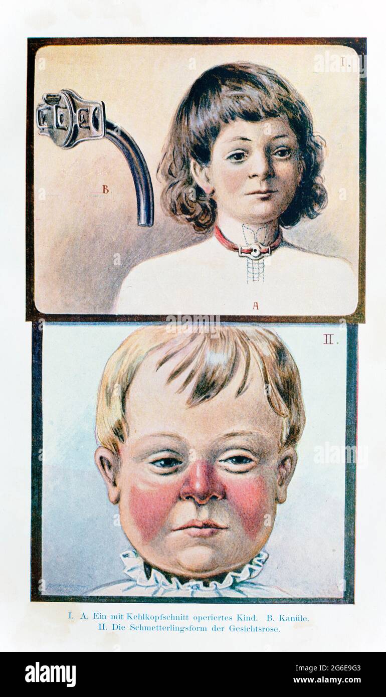 Kehlkopfschnitt und Schmetterlingsform von Gesichtserysipeln (Herpes zoster) Varicella-zoster-Virus, der praktische Hausarzt, ein Weg zur Gesundheit, 1901 Stockfoto