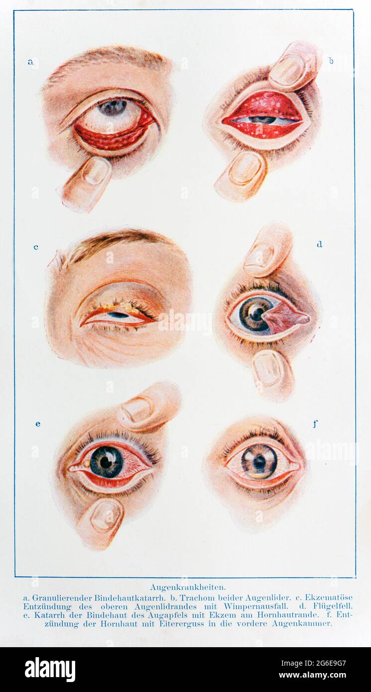 Verschiedene Augenkrankheiten, der praktische Hausarzt, EIN Weg zur Gesundheit, 1901, Breslau Stockfoto