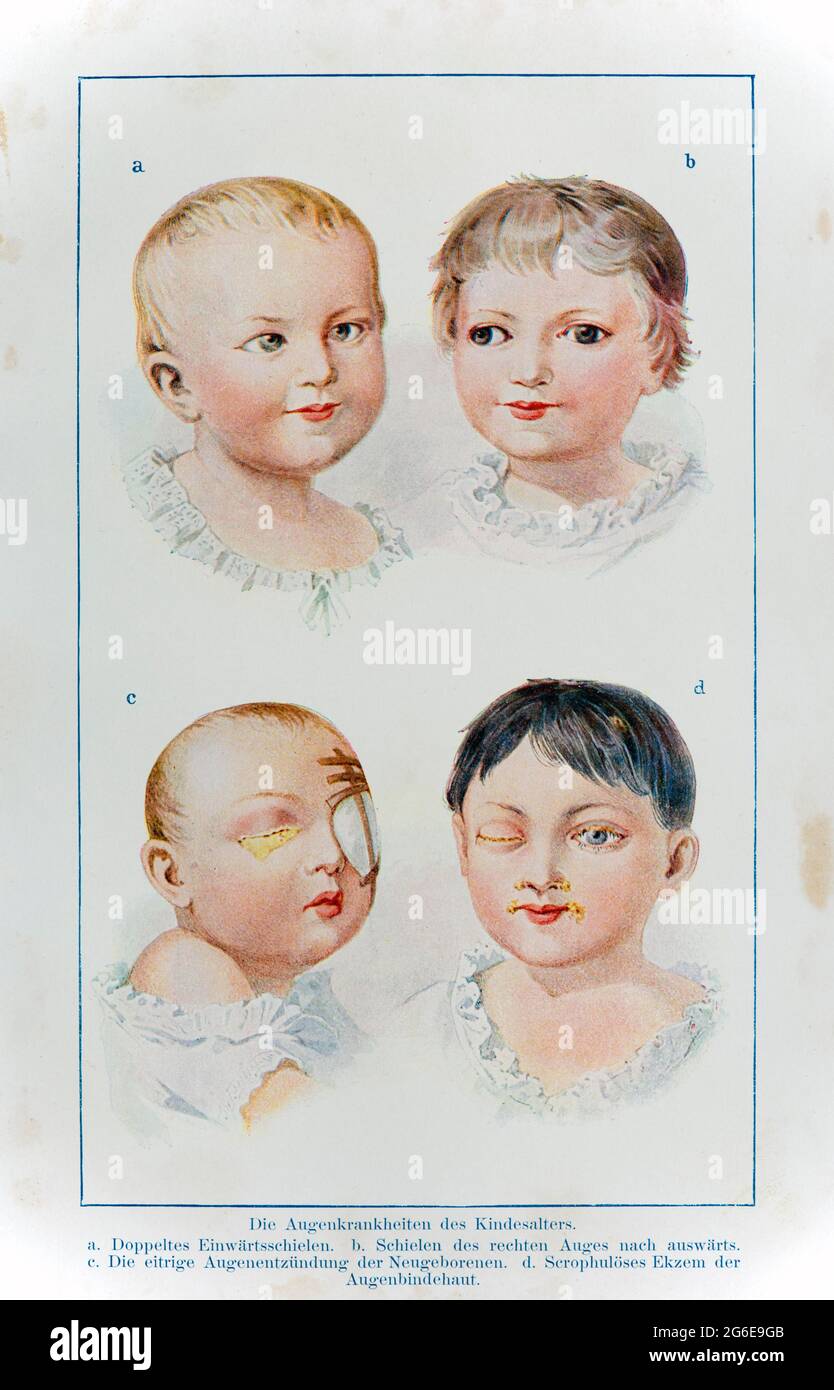 Die Augenkrankheiten bei Kindern, der praktische Hausarzt, EIN Weg zur Gesundheit, 1901, Breslau Stockfoto
