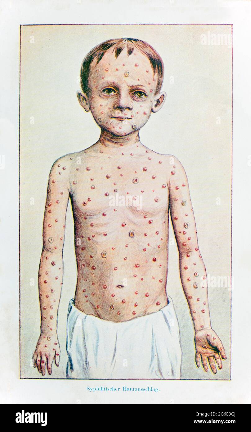 Hautausschläge bei Syphilis, der praktische Hausarzt, ein Weg zur Gesundheit, 1901, Breslau Stockfoto