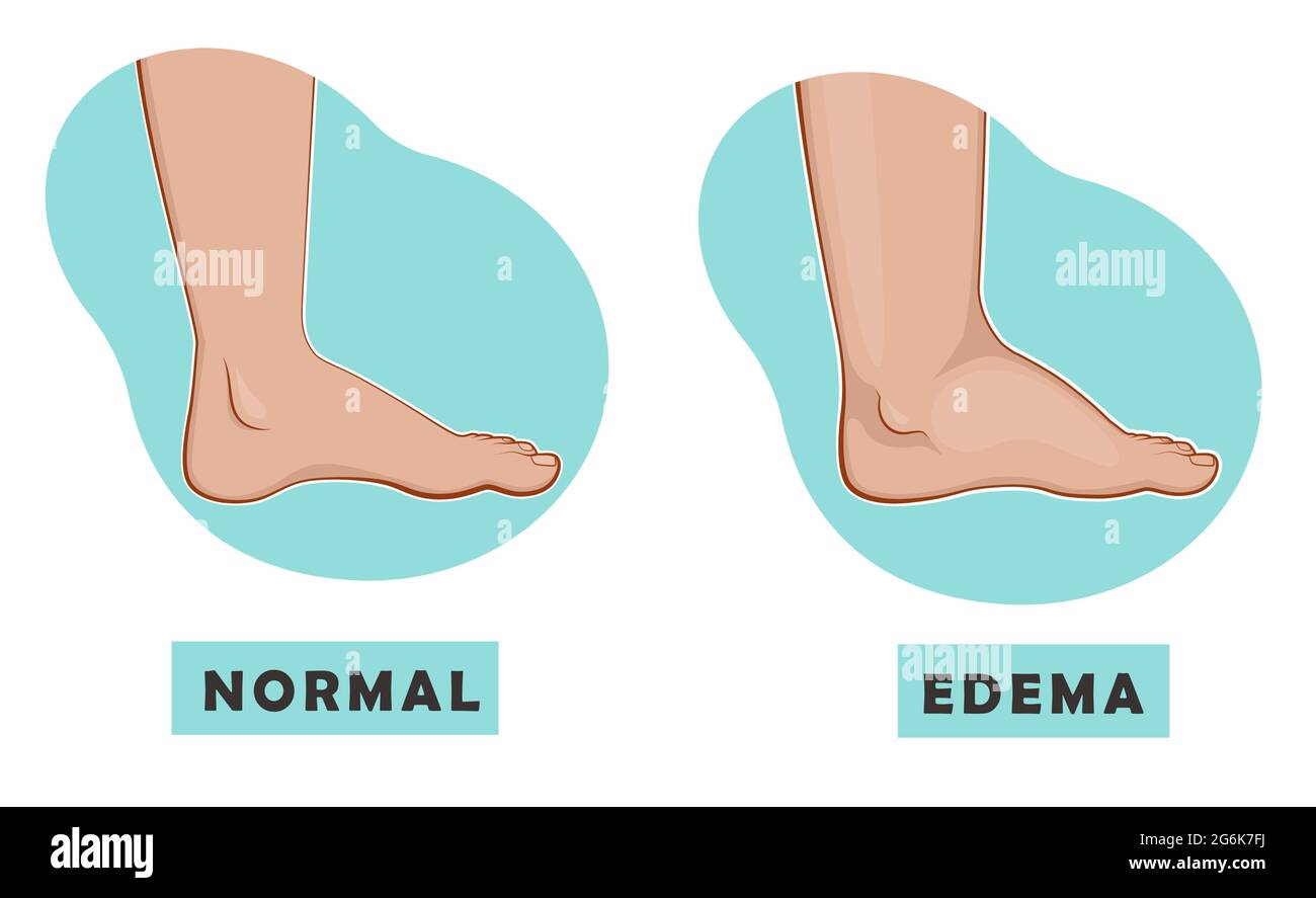 Ein geschwollener Fuß und Knöchel und ein normaler Fuß. Vektordarstellung der Krankheit Stock Vektor