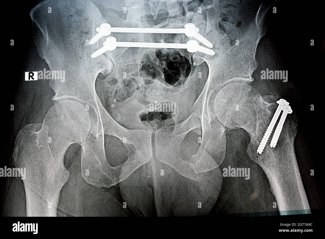 Einfaches Röntgenbild mit einem Frakturbecken, das mit 4 Schrauben und 2 Stäben befestigt ist, und Bruch eines größeren Trochanters des Oberschenkels, der mit 2 Schrauben befestigt ist Stockfoto