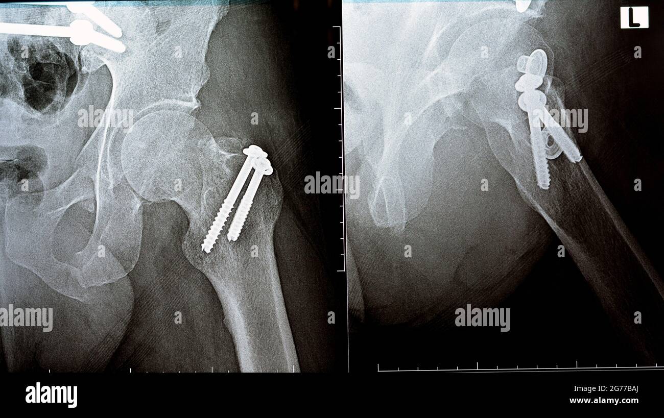 Offene Fraktur Stockfotos Und Bilder Kaufen Alamy