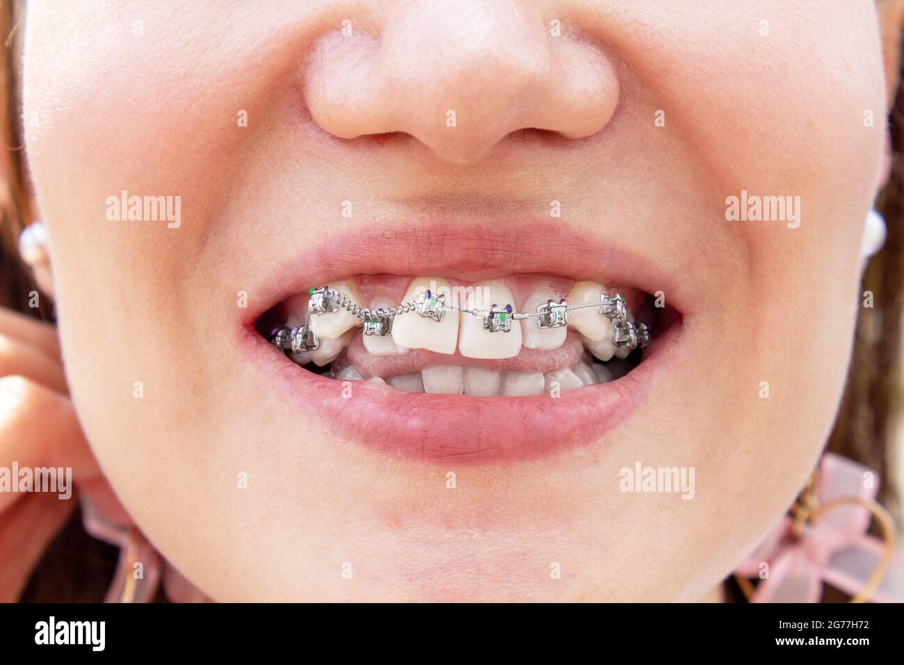 Gebogene weibliche Zähne, nach dem Installieren von Zahnspangen. Nahaufnahme der Zähne nach der