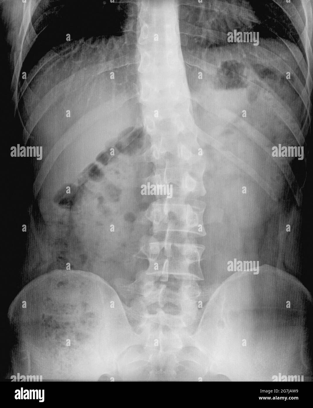 Röntgenfilm der Wirbelsäulenverkrümmung (Skoliose). Schwere medizinische Skoliose. Diagnose des Patienten mit Röntgenaufnahmen. Backbone- und Gelenkdiagnose Stockfoto