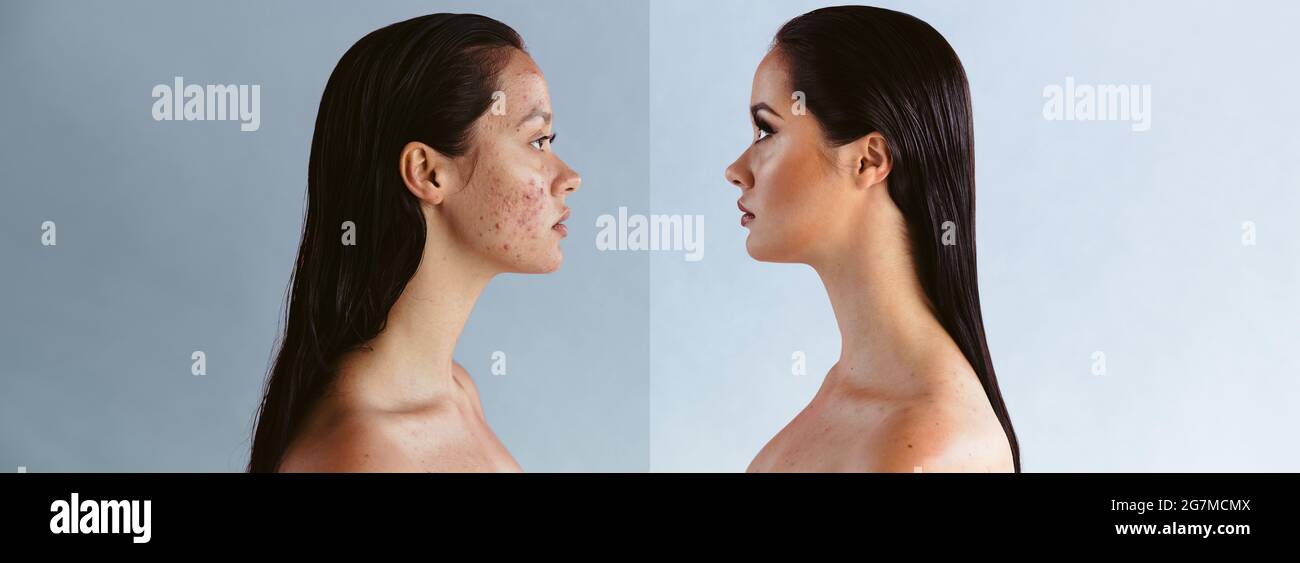 Weitwinkelaufnahme einer Frau, die die Kraft des Make-ups zeigt, indem sie die Unvollkommenheiten der Haut versteckt. Vor und nach Schuss der Frau leiden an Akne-Problem. Stockfoto