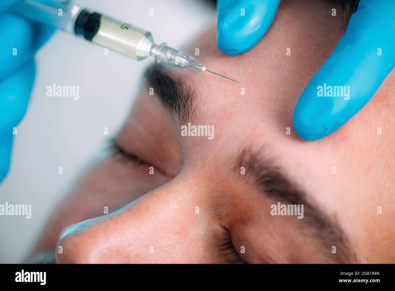 Behandlung des dermalen Füllstoffes Stockfoto