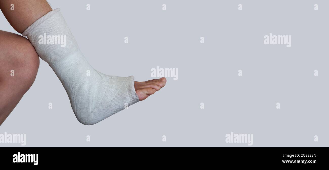 Gebrochenes Bein mit dem Wurf liegt auf dem Knie des anderen Beins. Stockfoto