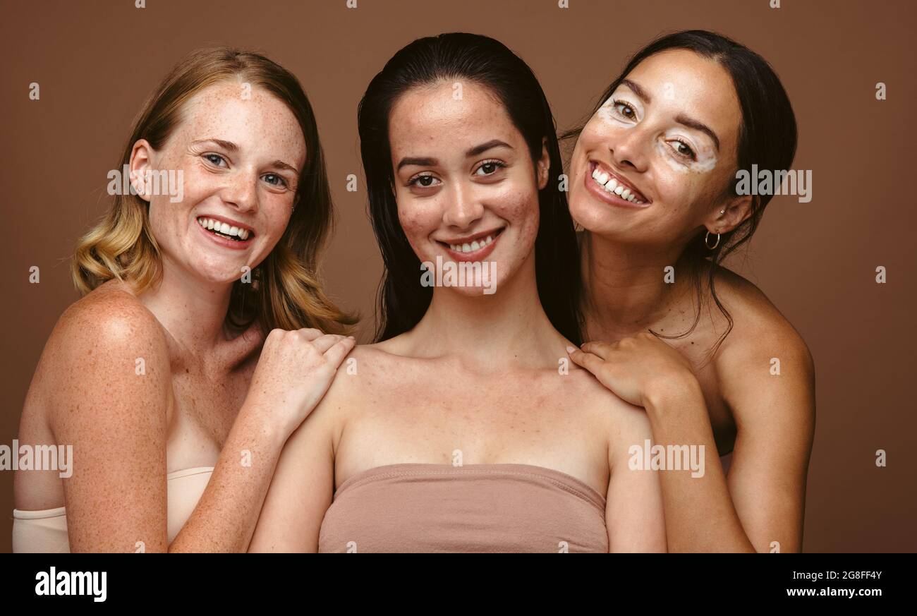 Nahaufnahme von Frauen mit Hautproblemen zusammen auf braunem Hintergrund. Porträt von drei selbstbewussten Frauen mit Hautzustand. Stockfoto