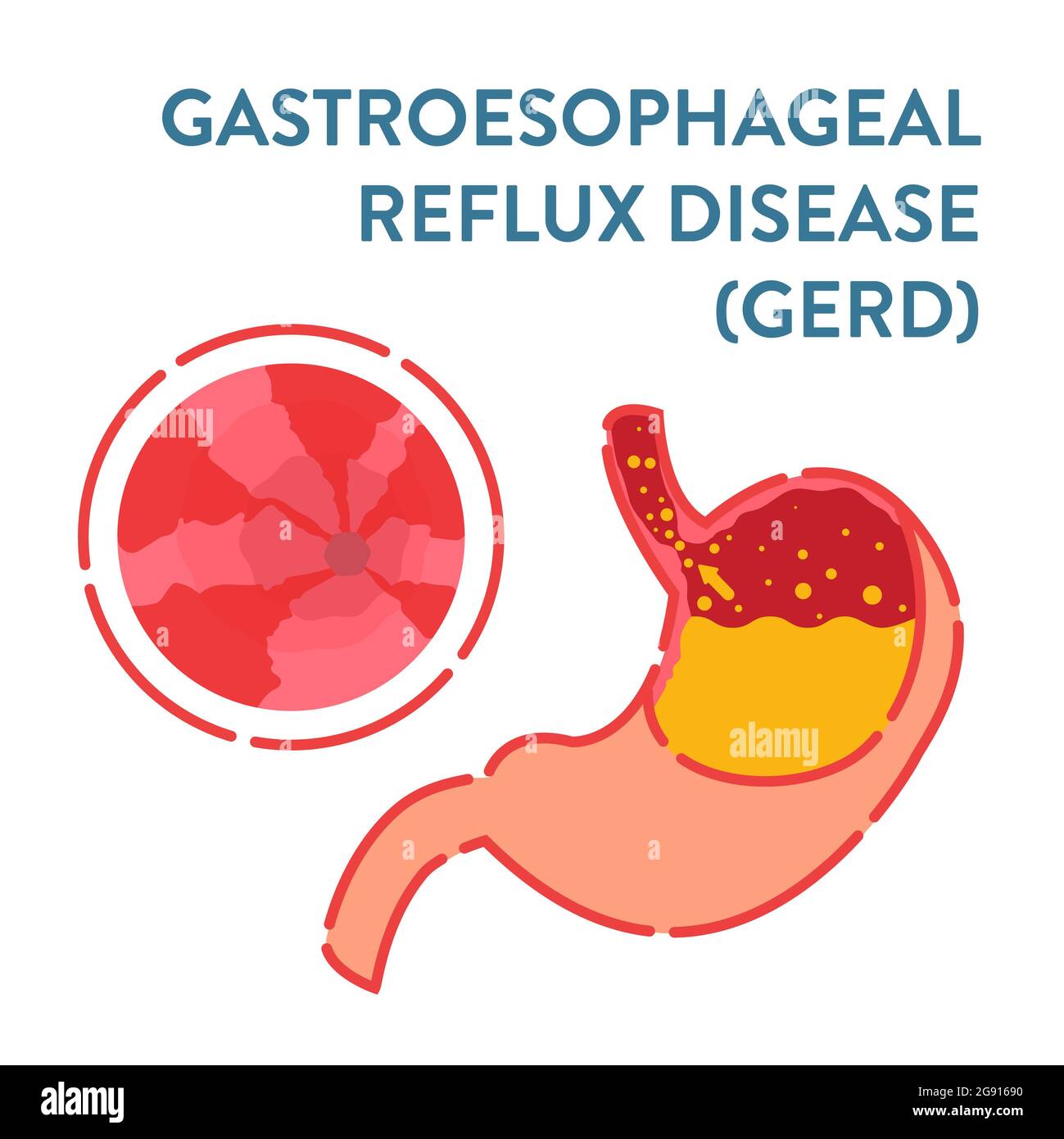Gastroösophageale Refluxkrankheit, Illustration Stockfoto