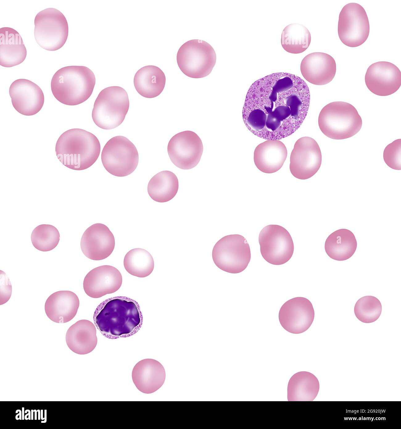 Geschwollene rote Blutkörperchen / Makrozytose Stockfoto