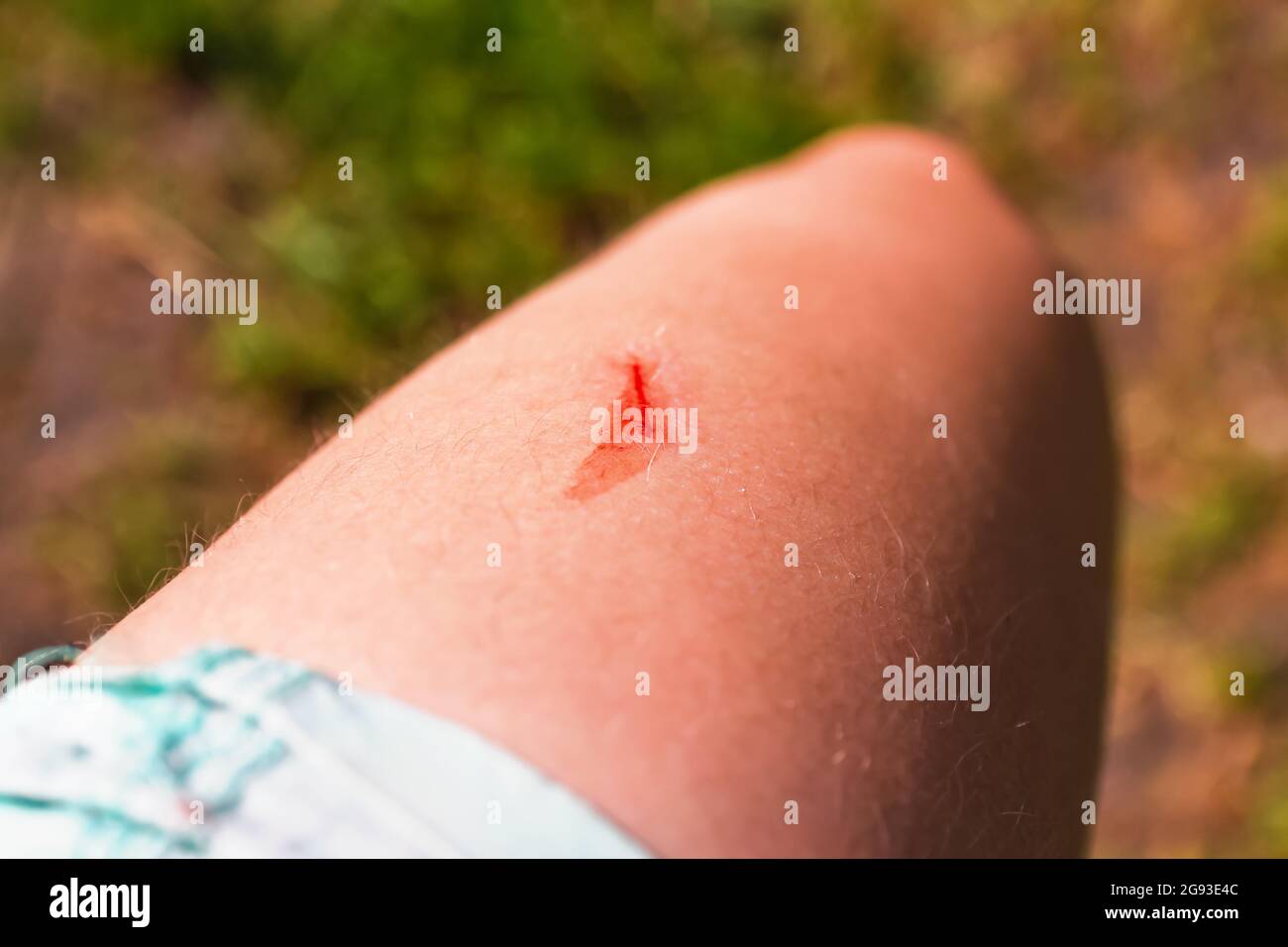 Frische Wunde am Bein, Oberschenkel mit Blut. Hautstruktur. Body positive - Körperhaar. Frauenbein. Der rote Kratzer blutet. Erste Hilfe. Ein Fleck von Stockfoto