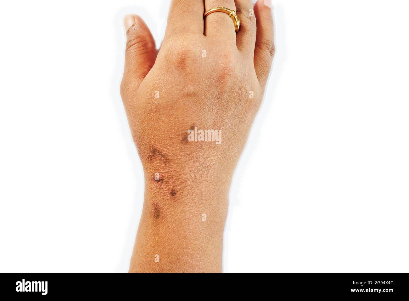 Trockene, dehydrierte und rissige Haut der asiatischen Frauen Hand mit schwarzen Marken Dermatitis Problem des Ausschlags, Allergieausschlag Stockfoto