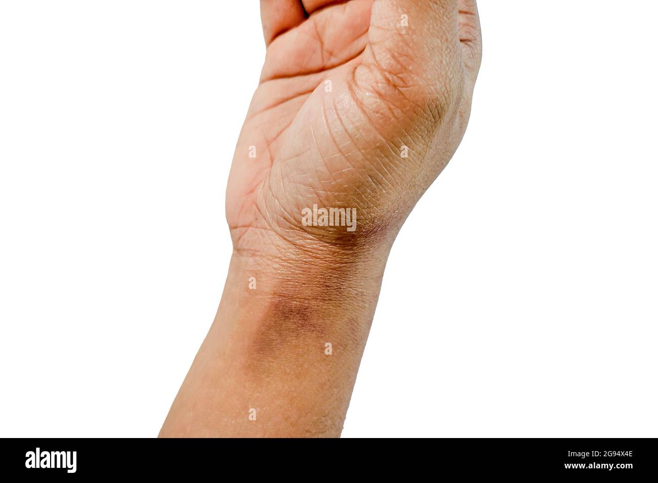 Nahaufnahme der asiatischen Frauen Hand mit schwarzen Marken Dermatitis Problem des Ausschlags, Allergieausschlag Stockfoto