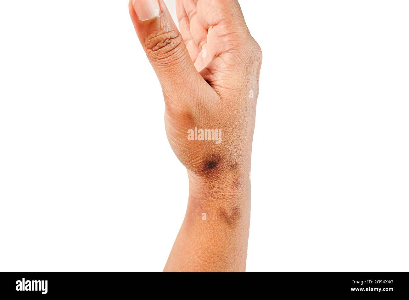 Trockene, dehydrierte Nahaufnahme der asiatischen Frauen Hand mit mehreren tiefen schwarzen Marken Dermatitis Problem des Ausschlags, Allergieausschlag Stockfoto
