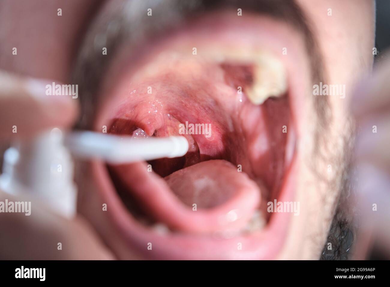 Nahaufnahme eines Mannes Mund mit einem Spray, um ein Aphthen oder Halsschmerzen zu behandeln. Stockfoto