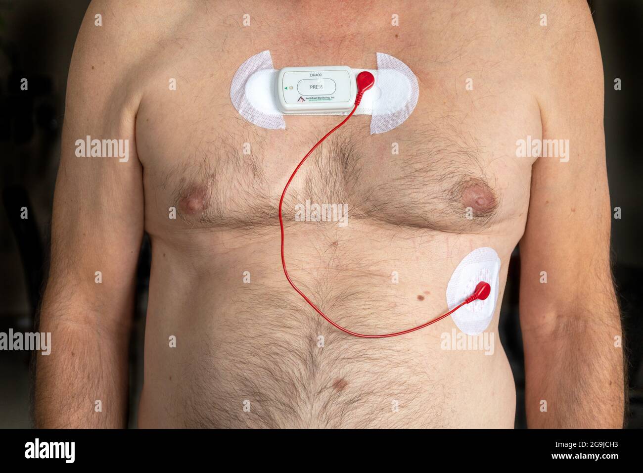 Ein Holter-Herzmonitor, der an EINE Thorax kaukasischer männlicher Patienten angeschlossen ist, um die elektrische Aktivität des Herzens bis zu 72 Stunden lang aufzuzeichnen, misst die Stockfoto