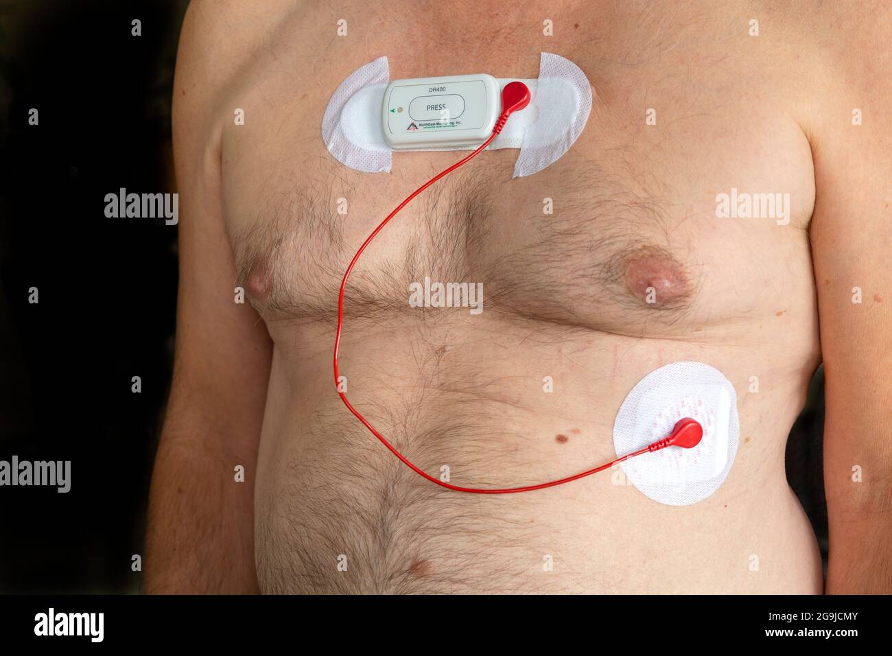 Holter Heart Monitor bei männlichen kaukasischen Patienten Thorax zur Aufzeichnung der elektrischen Aktivität des Herzens für bis zu 72 Stunden, Myokarditis Stockfoto