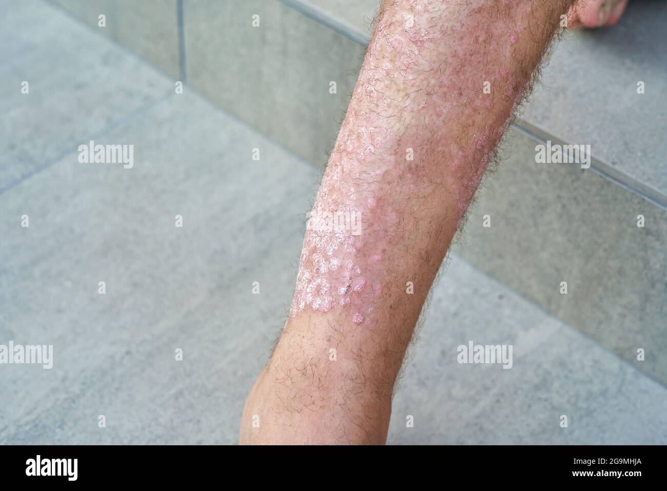 Schwere Psoriasis am Bein eines Mannes in Nahaufnahme. Stockfoto