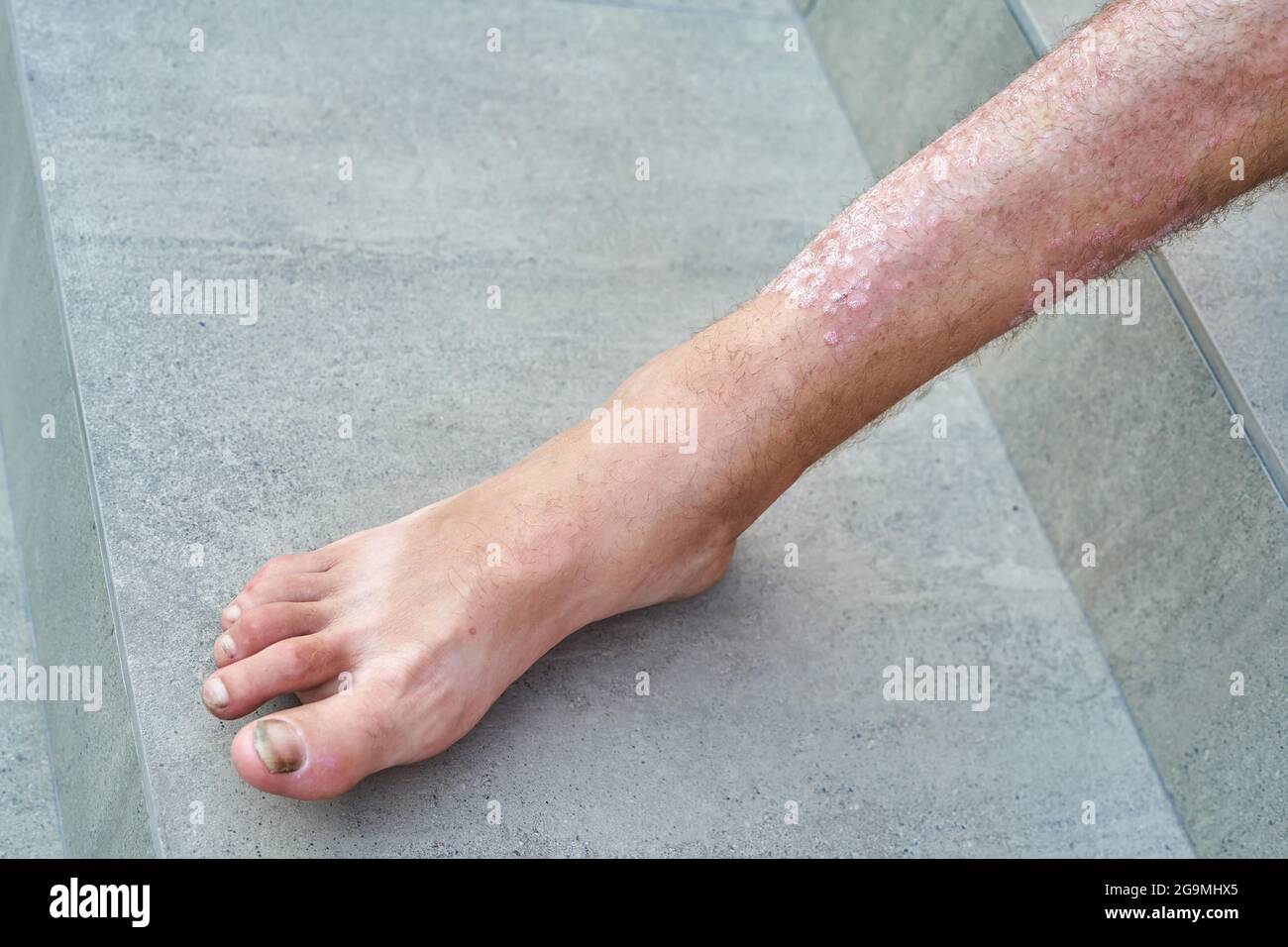 Schwere Psoriasis am Bein eines Mannes in Nahaufnahme. Stockfoto