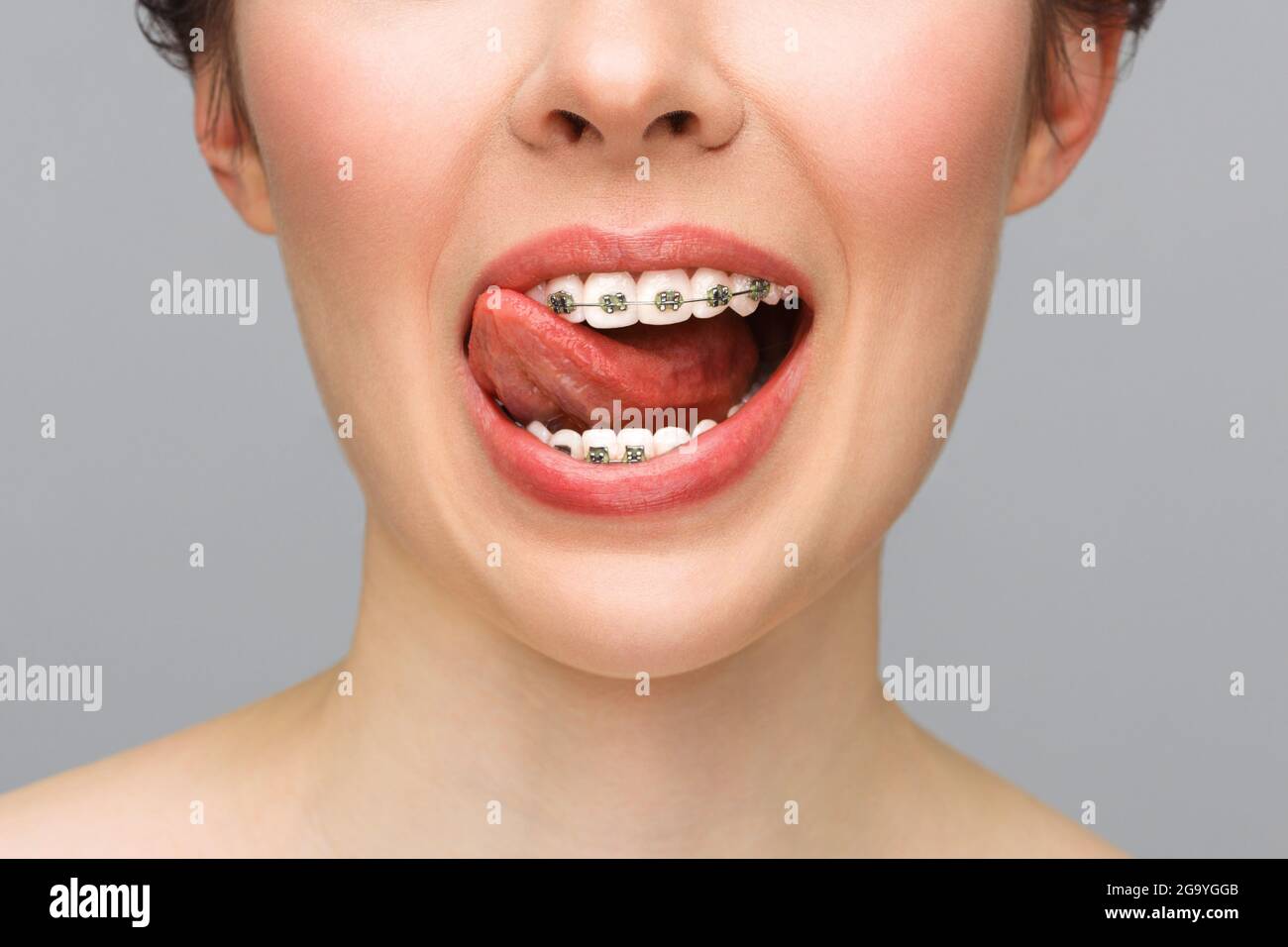 Kieferorthopädische Behandlung. Konzept Der Zahnpflege. Nahaufnahme Keramik- und Metallhalterungen an den Zähnen. Schönes Lächeln mit Zahnspangen. Stockfoto