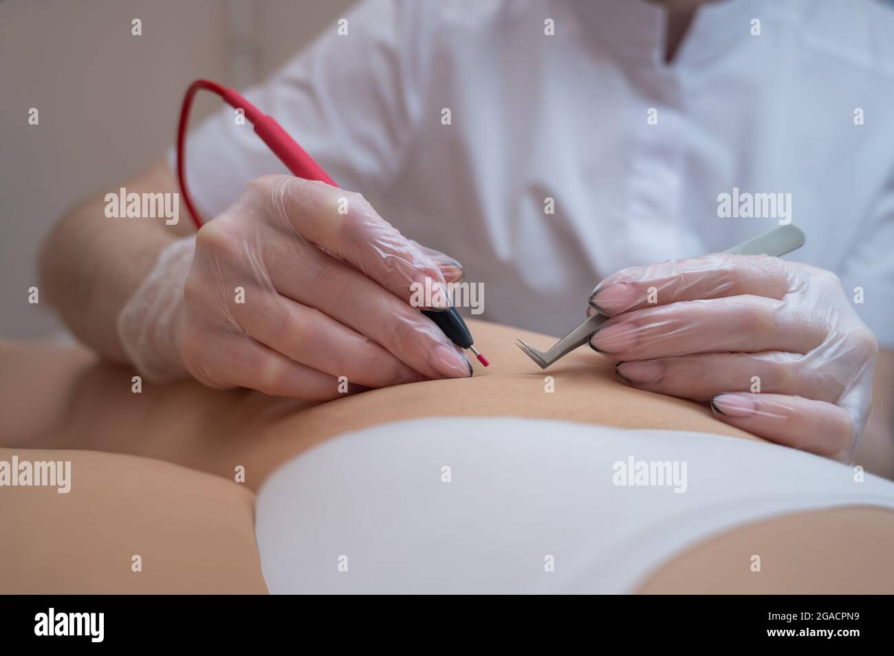 Der Arzt führt eine Elektroepilation der Bikinizone bei einer Frau im Salon  durch. Eine alternative Möglichkeit, unerwünschte Körperhaare dauerhaft zu  entfernen Stockfotografie - Alamy