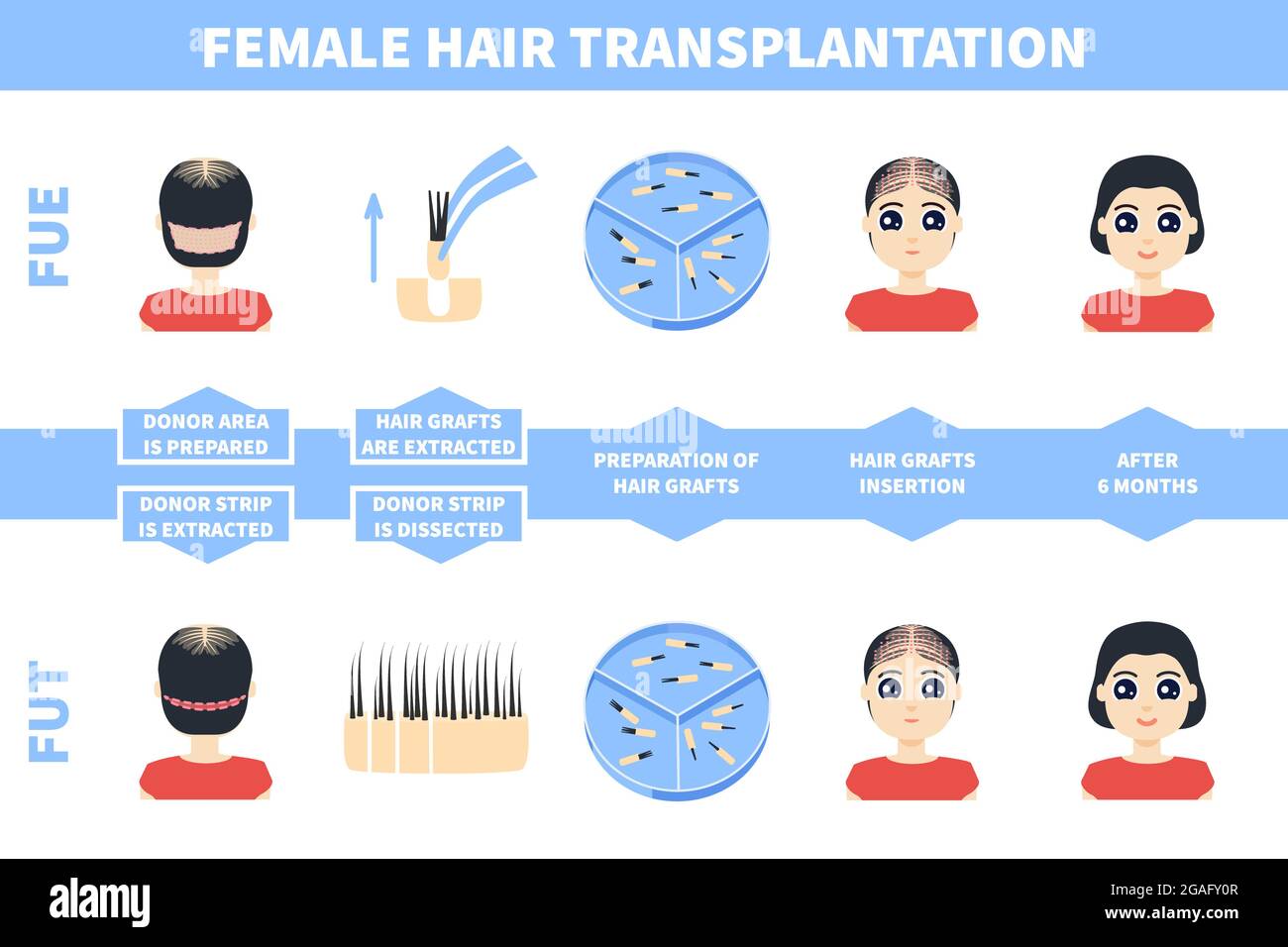 Haartransplantation bei Frauen, Illustration Stockfoto