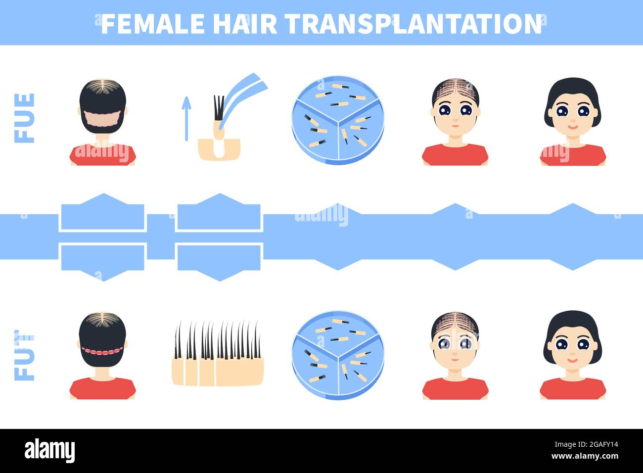 Haartransplantation bei Frauen, Illustration Stockfoto