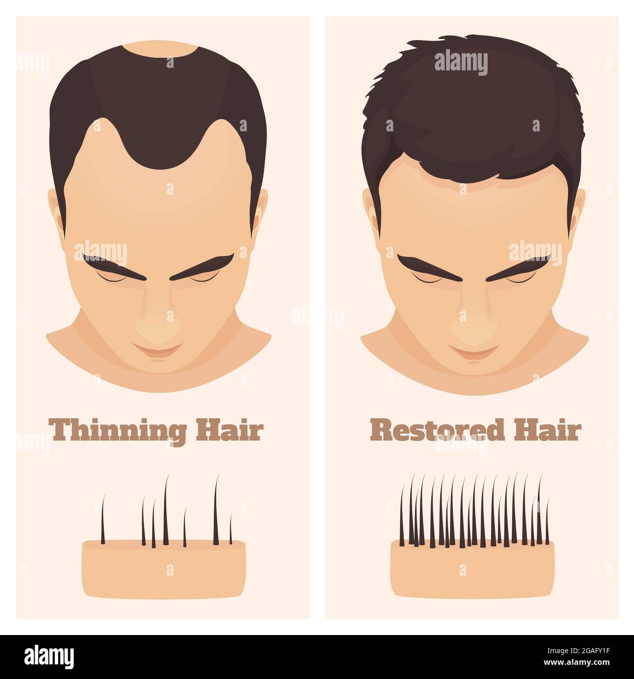Männliche Alopezie, Illustration Stockfoto