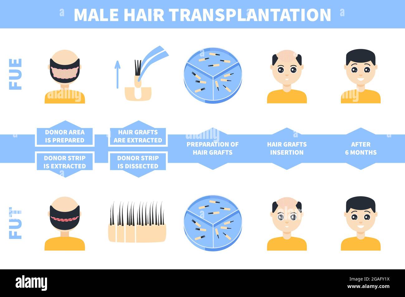 Haartransplantation bei Männern, Illustration Stockfoto