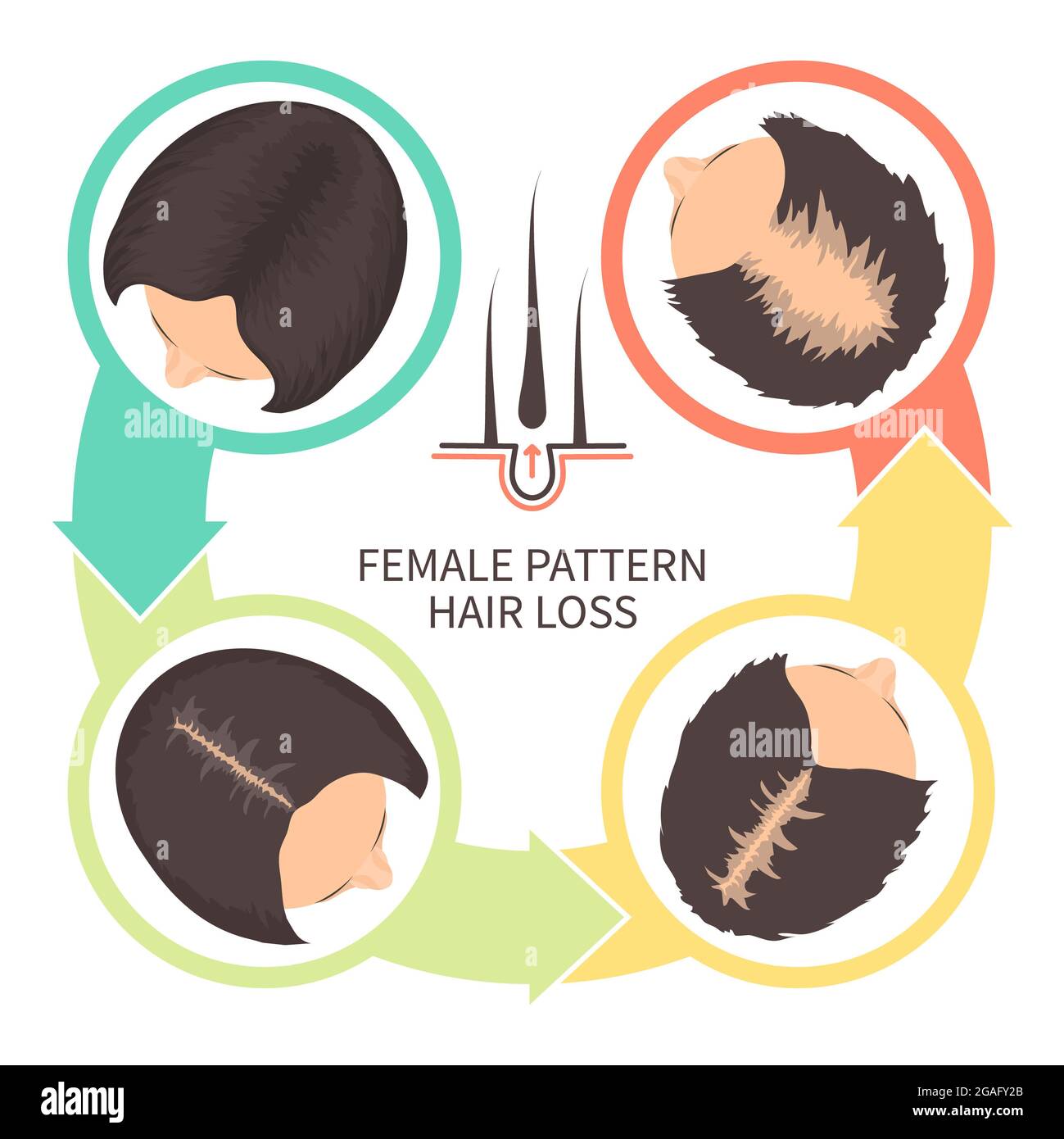 Weiblicher Haarausfall, Illustration Stockfoto