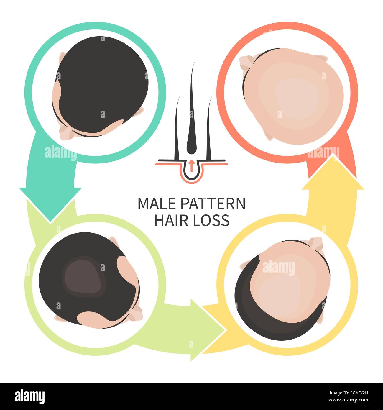 Haarausfall nach männlichem Muster, Illustration Stockfoto