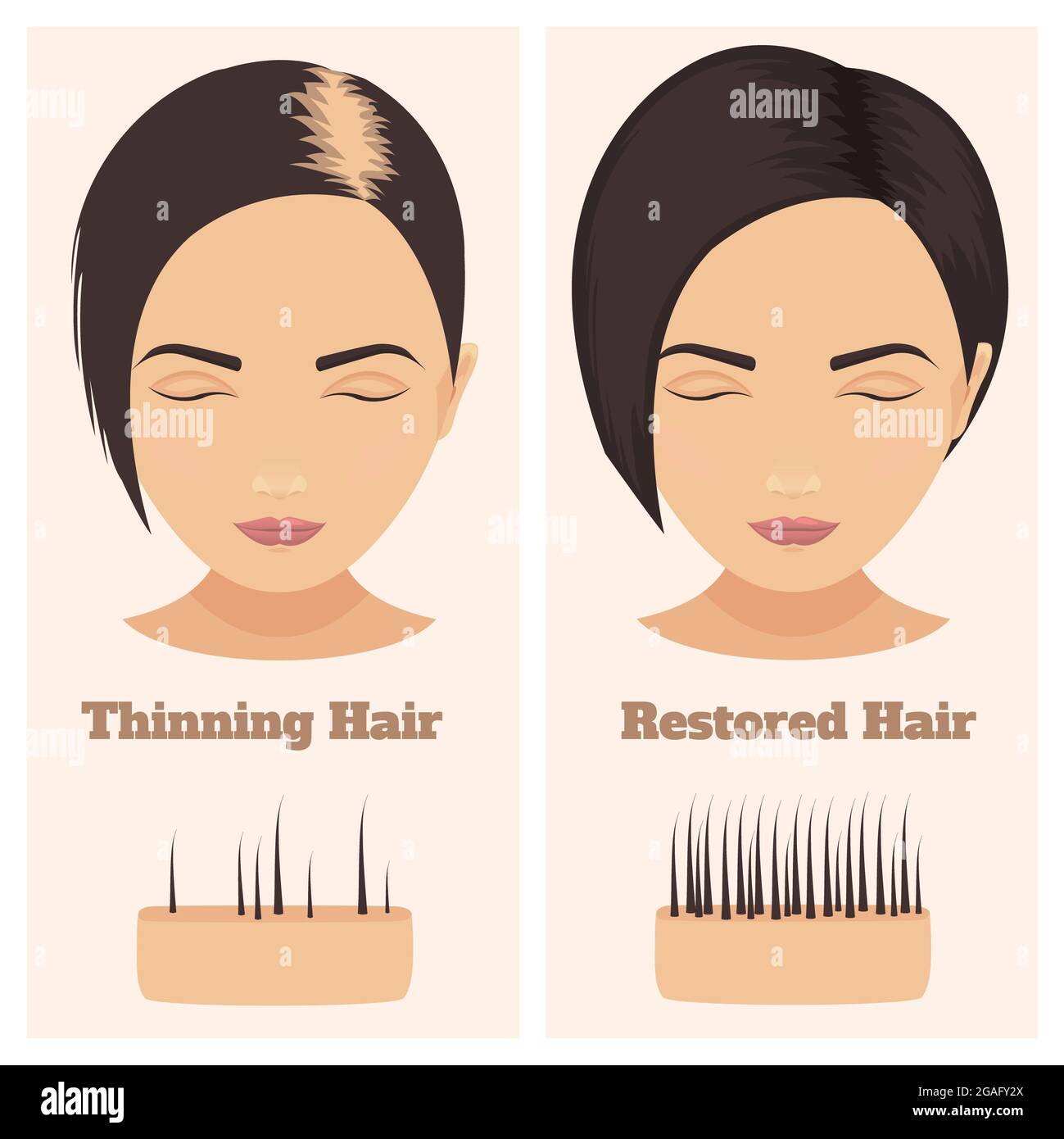 Weibliche Alopezie, Illustration Stockfoto