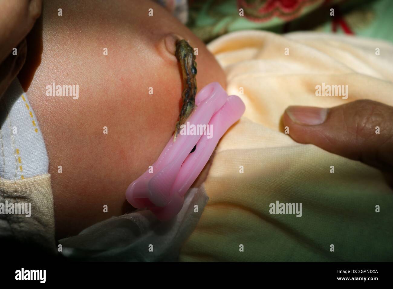 Nabelschnur des Neugeborenen, das am Bauchnabel befestigt ist Stockfoto