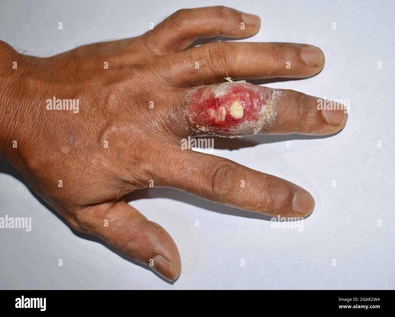 Schmerzhafter Karbunkel oder Abszess mit umgebender Cellulitis oder Staphylokokken-/Streptokokken-Hautinfektion am Mittelfinger des asiatischen burmesischen männlichen Paties Stockfoto