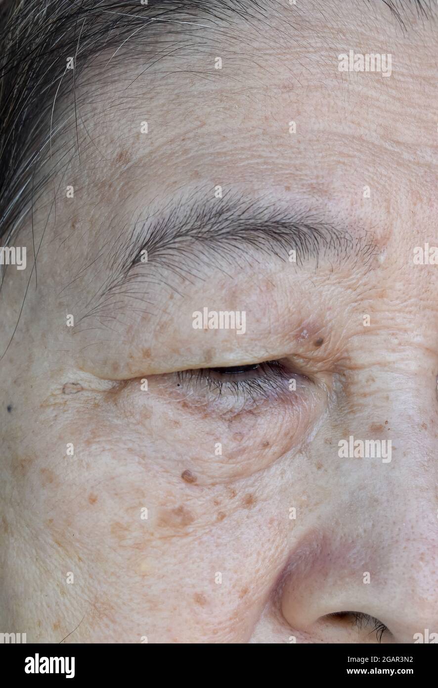 Alternde Hautfalten oder Hautfalten oder Falten und Alterungspunkte im Gesicht, insbesondere um das Auge einer älteren südostasiatischen, chinesischen Frau. Nahaufnahme. Stockfoto